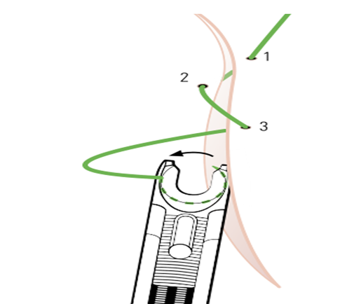 镜下缝合-腔内缝合器缝合要领